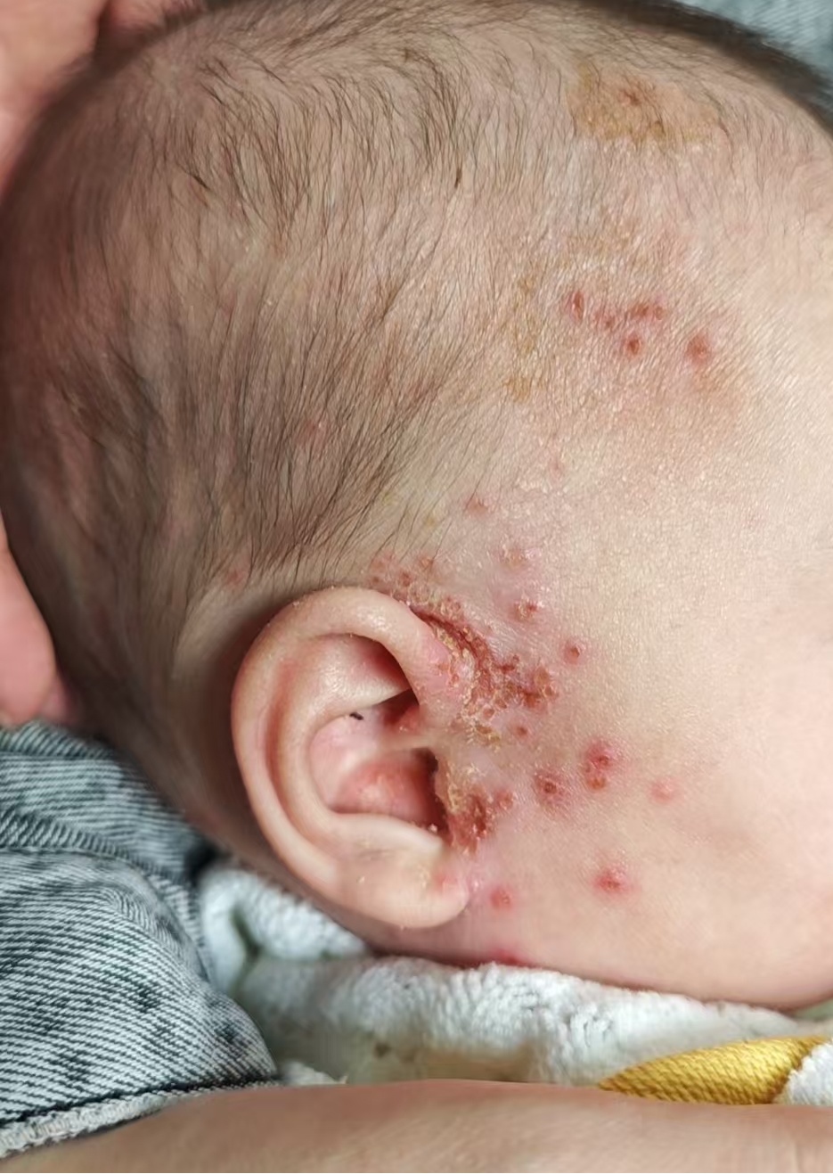 密密麻麻，1岁宝宝长满“痘痘”！竟是因为姥姥的一个疏忽