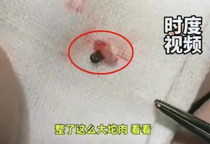 被蜱虫咬伤的处理方法_蜱虫叮咬的危害与预防_脾虫咬后的伤口图