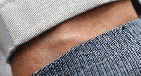 被蜱虫咬伤的处理方法_蜱虫叮咬的危害与预防_脾虫咬后的伤口图