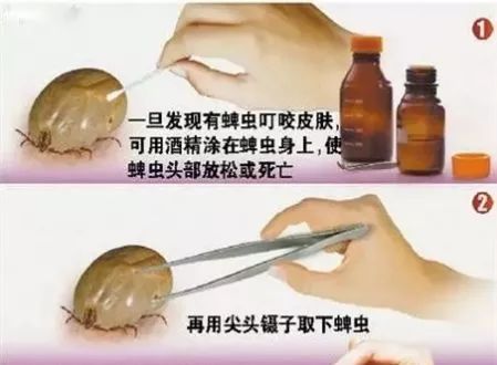 脾虫咬后的伤口图_蜱虫咬人案例_蜱虫叮咬症状