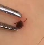 蜱虫叮咬症状_脾虫咬后的伤口图_蜱虫咬人案例