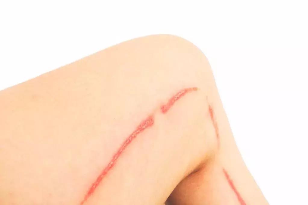 脾虫咬后的伤口图_夏季蜱虫叮咬症状_蜱虫叮咬急救方法