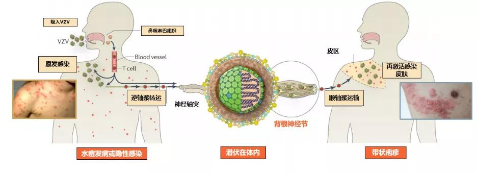 水痘病毒 带状疱疹·_带状疱疹病毒性水痘怎么引起的_病毒带状疱疹水痘图片